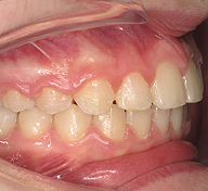Prominent Teeth  After